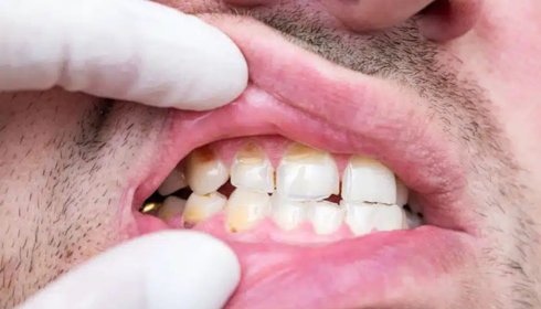  Acidic Drinks and Enamel Erosion: What Early Damage on Front Teeth Looks Like