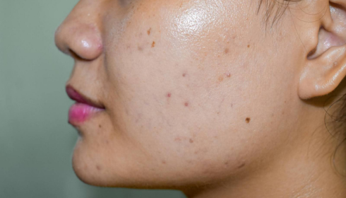 Hyperpigmentation from Old Pimples: Everyday Habits That Help Fade Dark Marks