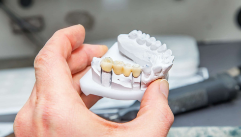 Replacing Missing Teeth: Bridges, Implants and Dentures Explained in Simple Terms