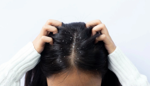 Scalp Care Basics: Flakes, Itchiness and Product Buildup You Shouldn’t Ignore